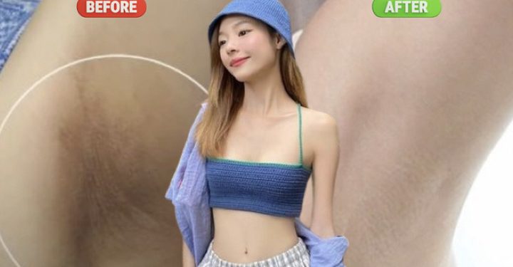 Bí quyết trị thâm vùng da dưới cánh tay cho người luôn thơm, da sáng sau 2 tuần