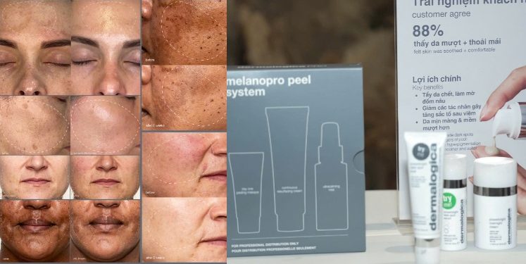 Cải thiện tình trạng nám da sau 6 tuần với giải pháp Powerbright Dark Spot Peel từ Dermalogica và Viện nghiên cứu về da quốc tế IDI Hoa Kỳ